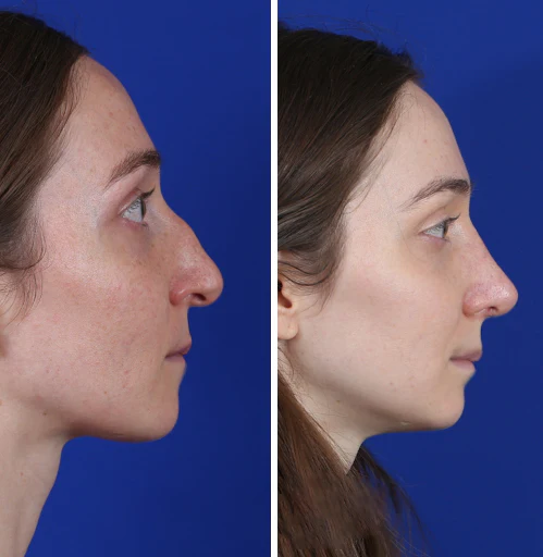 Nostafix™ Nose Corrector Device