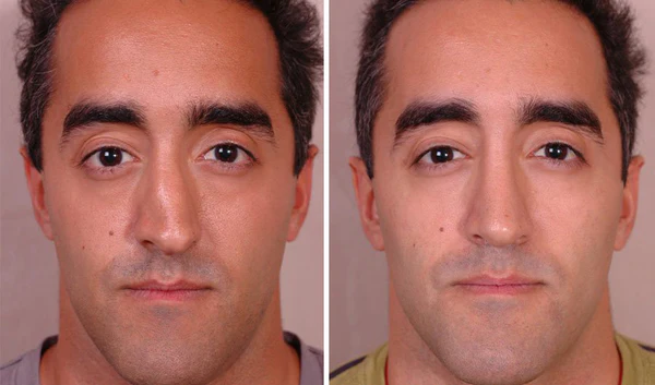 Nostafix™ Nose Corrector Device
