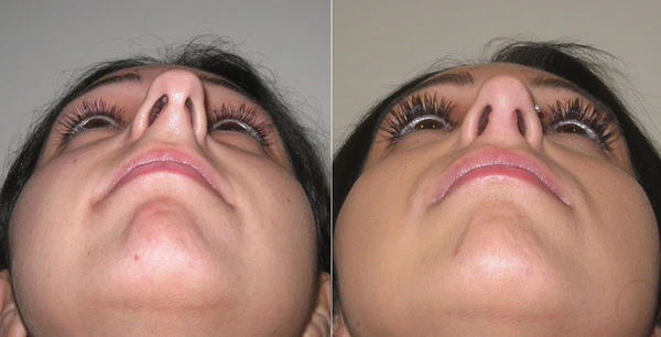 Nostafix™ Nose Corrector Device
