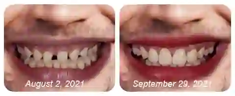 Nurbini™ Adjustable Snap Prosthesis