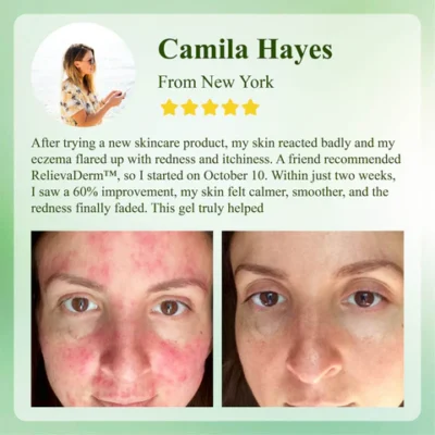 RelievaDerm™ Aloe SkinTherapy HydratingGel