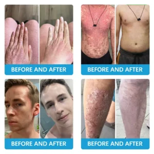 Steroid free💎 𝗧𝗢𝗗𝗔𝗛𝗢𝗙™ 𝗕𝗲𝗲 𝗩𝗲𝗻𝗼𝗺 𝗠𝘂𝗹𝘁𝗶-𝗦𝘆𝗺𝗽𝘁𝗼𝗺 𝗧𝗿𝗲𝗮𝘁𝗺𝗲𝗻𝘁 𝗖𝗿𝗲𝗮𝗺
