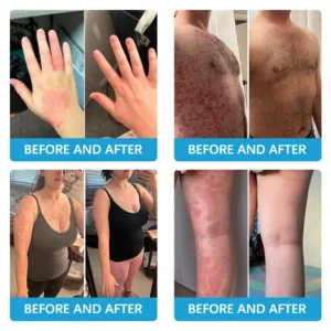 Steroid free💎 𝗧𝗢𝗗𝗔𝗛𝗢𝗙™ 𝗕𝗲𝗲 𝗩𝗲𝗻𝗼𝗺 𝗠𝘂𝗹𝘁𝗶-𝗦𝘆𝗺𝗽𝘁𝗼𝗺 𝗧𝗿𝗲𝗮𝘁𝗺𝗲𝗻𝘁 𝗖𝗿𝗲𝗮𝗺