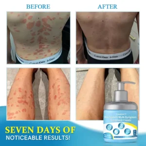 Steroid free💎 𝗧𝗢𝗗𝗔𝗛𝗢𝗙™ 𝗕𝗲𝗲 𝗩𝗲𝗻𝗼𝗺 𝗠𝘂𝗹𝘁𝗶-𝗦𝘆𝗺𝗽𝘁𝗼𝗺 𝗧𝗿𝗲𝗮𝘁𝗺𝗲𝗻𝘁 𝗖𝗿𝗲𝗮𝗺