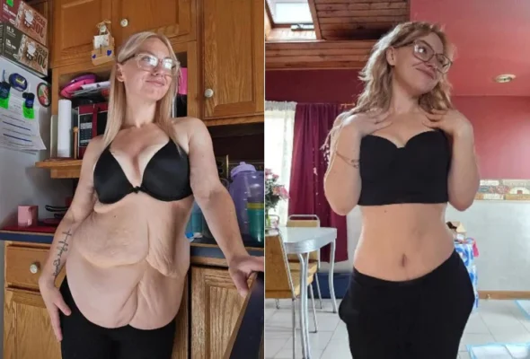 Neslemy™ Ion Lift Correction Lymph Drainage Bra