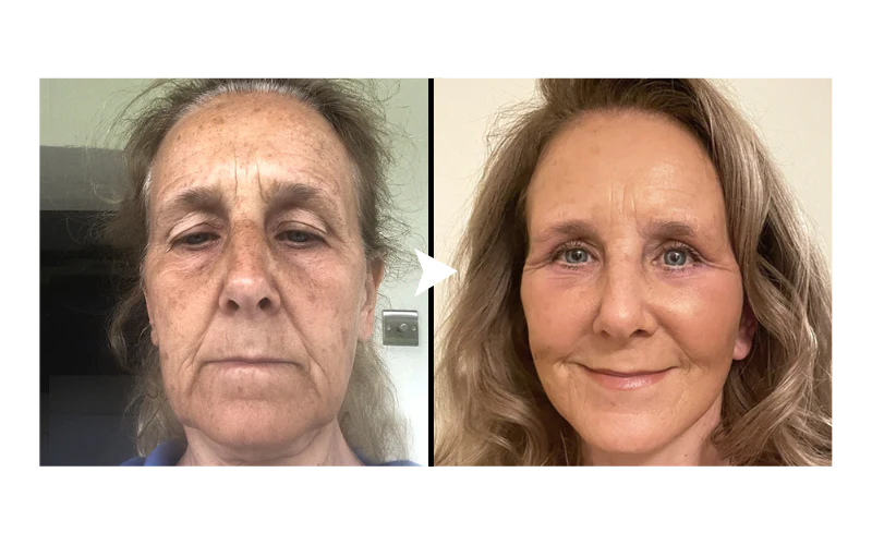 Biancat™ VDefine Face Lifting Tape