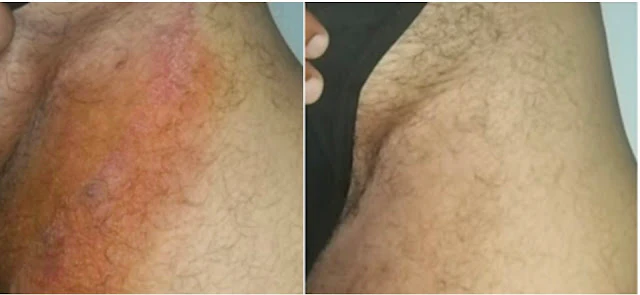 AEXZR™ Bee Venom Genital Itch Relief Cream