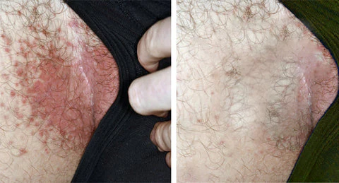 AEXZR™ Bee Venom Genital Itch Relief Cream