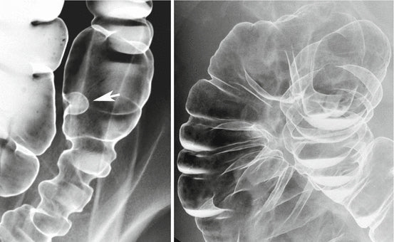 AEXZR™ Colon and Polyps Removal Cure