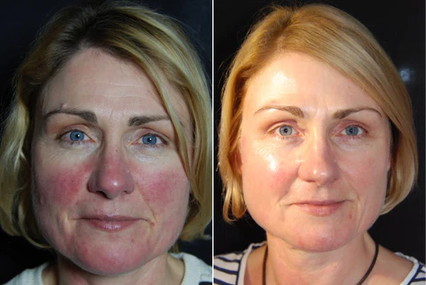 AEXZR™ Rosacea Cure Serum