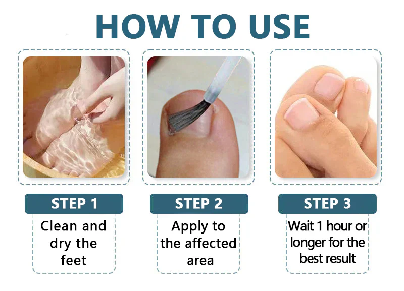 Bee Venom Nail Fungus Treatment Solution