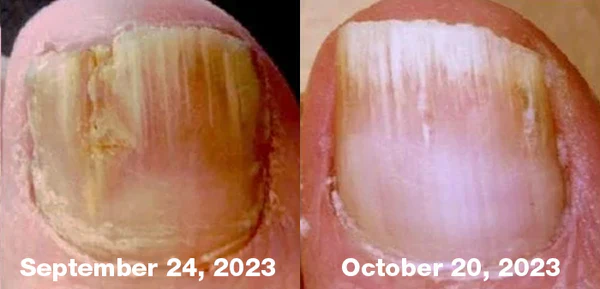 Bee Venom Nail Fungus Treatment Solution