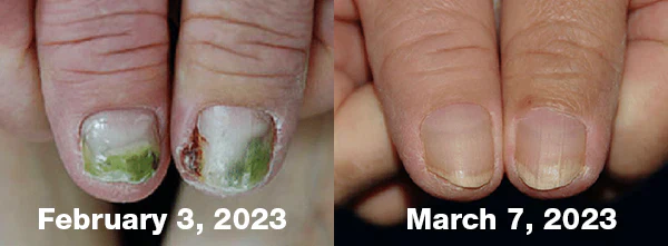 Bee Venom Nail Fungus Treatment Solution