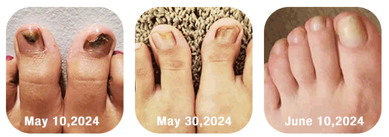 Bee Venom Nail Fungus Treatment Solution