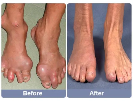 Bikenda™ Smart Multi-functional Non-invasive Laser Targeted Therapy: High Uric Acid Arthritis and Blood Sugar Detection Device