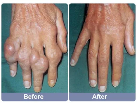 Bikenda™ Smart Multi-functional Non-invasive Laser Targeted Therapy: High Uric Acid Arthritis and Blood Sugar Detection Device
