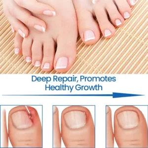 Ceoerty™ Herbal Formula nail fungus paronychia treatment gel