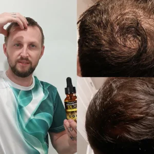 Ceoerty™ FollicaBoost 5% Minoxidil Hair Care Oil