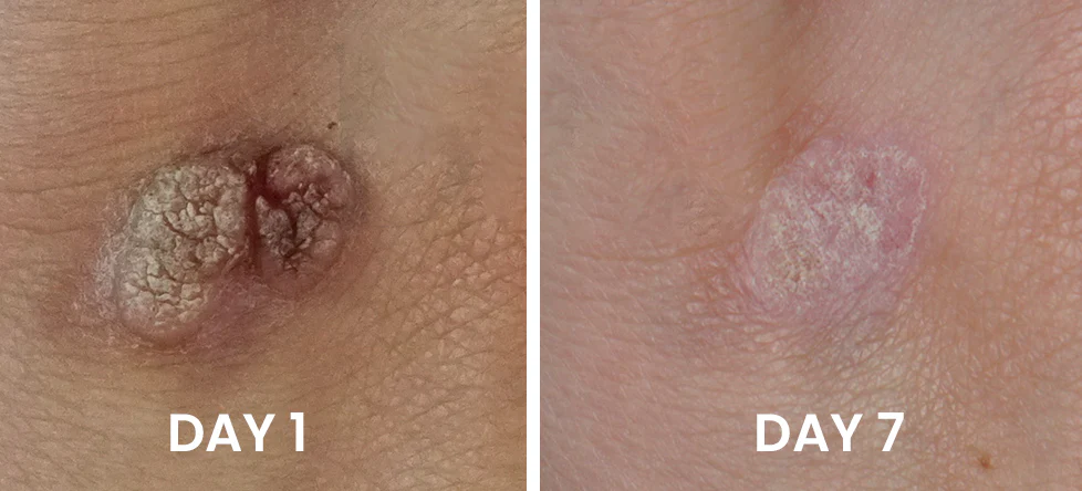 DermiBliss™ Genital Warts Remover Cream