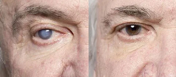 EyeRelief Therapeutic Cleansing Wipes