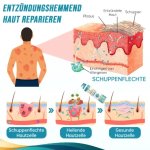 Ourlyard™ Psoriasis- und Ekzem-Naturheilmittel-Spray