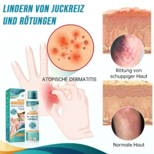Ourlyard™ Psoriasis- und Ekzem-Naturheilmittel-Spray