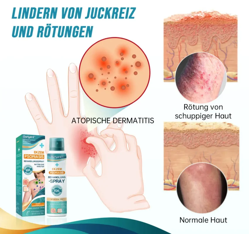Ourlyard™ Psoriasis- und Ekzem-Naturheilmittel-Spray