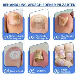 PureNail™ Die effektive Lösung gegen Nagelpilz – Für gesunde, schöne Nägel