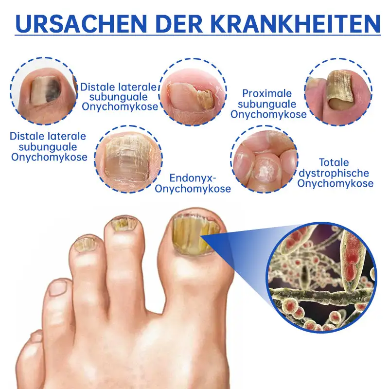 PureNail™ Die effektive Lösung gegen Nagelpilz – Für gesunde, schöne Nägel