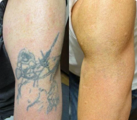VanInk™ Tattoo Dissolving Gel