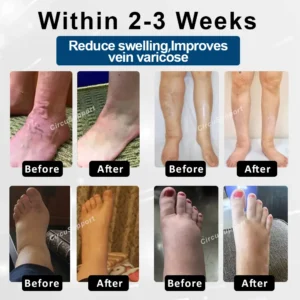 CircuSupport™ Magnetic EdemaCare Insoles