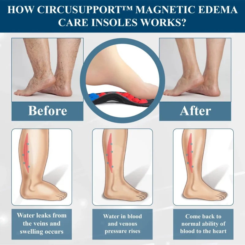 CircuSupport™ Magnetic EdemaCare Insoles