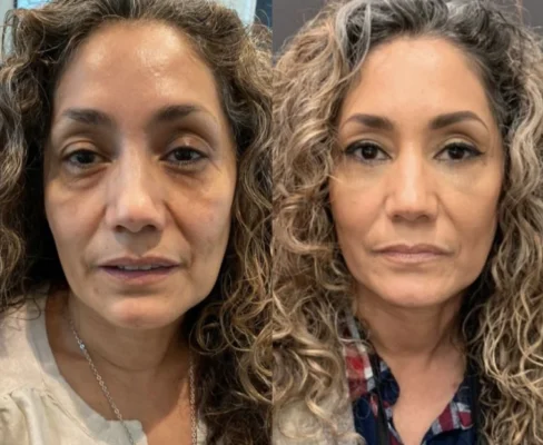 Flysmus™ Collagen Peptides Wrinkle Removal Cream