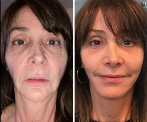Flysmus™ Collagen Peptides Wrinkle Removal Cream