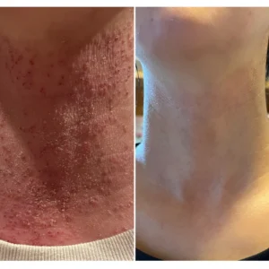 Furzero™ 20% Salicylic Acid Skin Treatment Cream