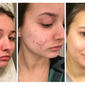 Furzero™ 20% Salicylic Acid Skin Treatment Cream