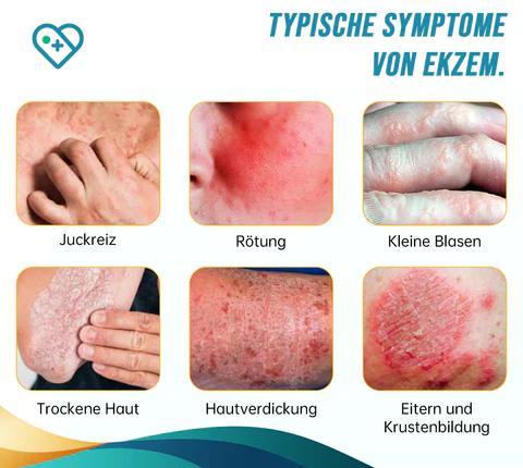 Psoriasis- und Ekzem-Naturheilmittel-Spray