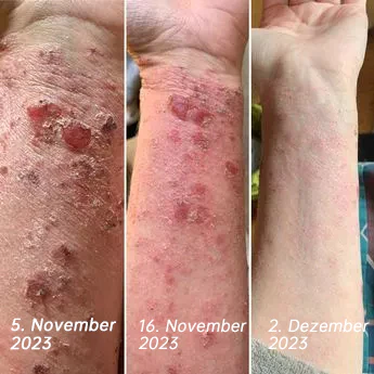 Psoriasis- und Ekzem-Naturheilmittel-Spray