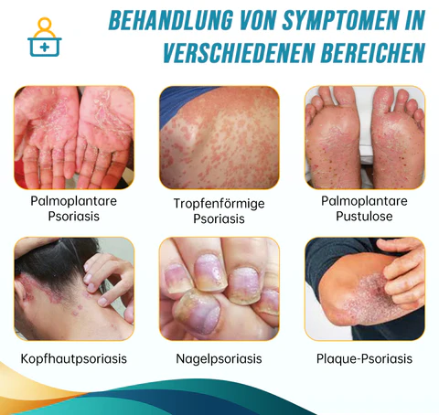 Psoriasis- und Ekzem-Naturheilmittel-Spray