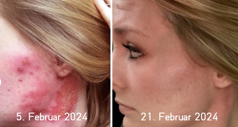 Psoriasis- und Ekzem-Naturheilmittel-Spray