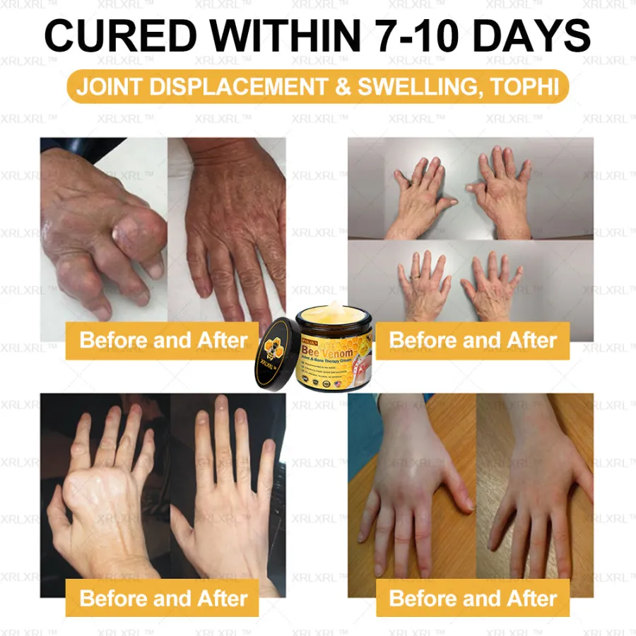 Raindew™ Bee Venom Pain Relief Bone Healing Cream