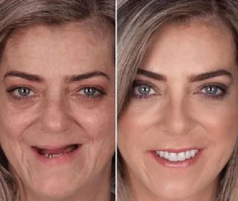 Seamless Smile Silicone Denture Kit