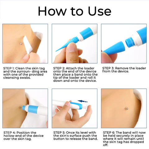 Seurico™ At-home Skin Tag Removal Pen