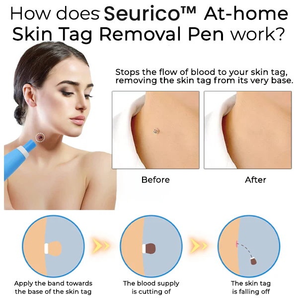 Seurico™ At-home Skin Tag Removal Pen
