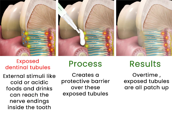 Wuize™ Sensitive Teeth Repairing Gel