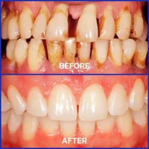 🐝𝐎𝐲𝐢𝐤𝐞𝐲™ Focussmile Bee Venom Treatment Oral Powder 🦷 (🇦🇺 TGA-Certified)
