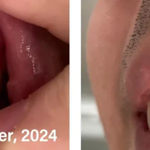 🐝𝐎𝐲𝐢𝐤𝐞𝐲™ Focussmile Bee Venom Treatment Oral Powder 🦷 (🇦🇺 TGA-Certified)