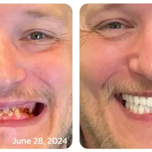 🐝𝐎𝐲𝐢𝐤𝐞𝐲™ Focussmile Bee Venom Treatment Oral Powder 🦷 (🇦🇺 TGA-Certified)