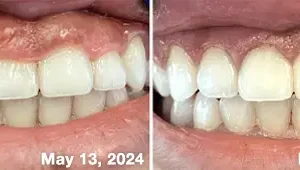 🐝𝐎𝐲𝐢𝐤𝐞𝐲™ Focussmile Bee Venom Treatment Oral Powder 🦷 (🇦🇺 TGA-Certified)