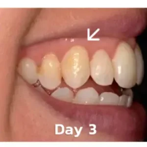 🐝𝐎𝐲𝐢𝐤𝐞𝐲™ Focussmile Bee Venom Treatment Oral Powder 🦷 (🇦🇺 TGA-Certified)